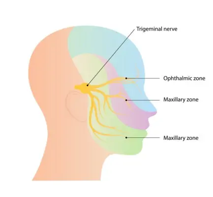 Trigeminal Neuralgia