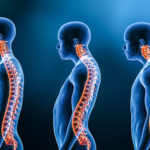 How Can Spinal Deformity Affect Daily Life?