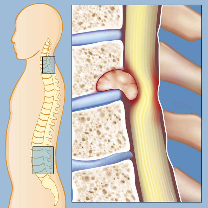 Understanding the procedure and what to expect during spinal tumor surgery?